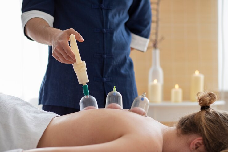 La Cupping Thérapie : Chine/ Hijama